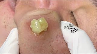 cystic acne blackhead whitehead removal  Relaxing Spa Acne Treatment [upl. by Yenttihw]