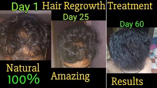 Amazing result hair regrowth new natural treatment [upl. by Osman]