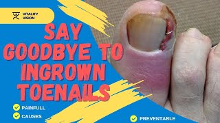 Say Goodbye to Ingrown Toenails [upl. by Breana259]