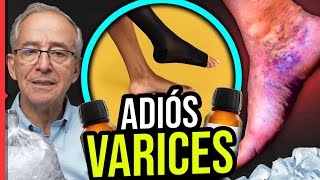 🔴 ADIÓS A LAS VARICES  Oswaldo Restrepo RSC [upl. by Asiuqram834]