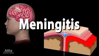 Meningitis Pathology Causes Symptoms Diagnosis and Treatment Animation [upl. by Ekalb46]