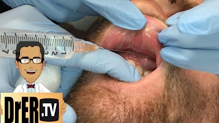 gum abscess drainage  Full VIDEO [upl. by Rebmit623]