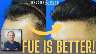 FUE is Better Than FUT Now  Dr Hasson of Hasson and Wong [upl. by Forkey]