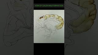 Vein Of Galen Malformation Artistic Impression VOGM [upl. by Risa]