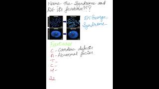 Identify The Syndrome and List the Features Syndromes MedicalMnemonics [upl. by Mehelhteb]