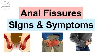 Anal Fissures Signs amp Symptoms amp Why They Occur  Acute vs Chronic Anal Fissures [upl. by Merna762]