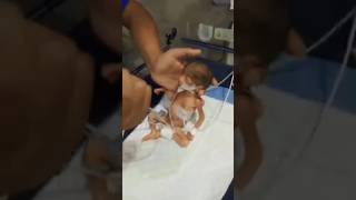 premature baby feeding 🤲🙏shorts viral shortsfeed foryou ytshorts trending baby cute fyp [upl. by Kelam959]