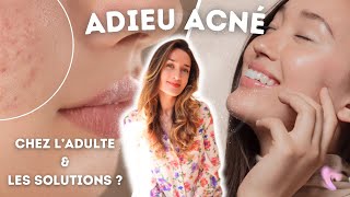 TIPS  COMMENT SE DÉBARRASSER DE LACNÉ ADULTE  cosmétiques alimentation stress solutions [upl. by Meagan701]