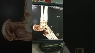 3D CT SCAN Osteomyelitis [upl. by Eelhsa480]