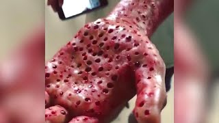 Do You Have Trypophobia The Fear of Holes  The Doctors [upl. by Yttisahc]