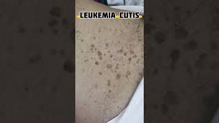 Chronic lymphocytic leukemia mrmc CLL leukimia pathology ⁴ [upl. by Ynohtnacram]