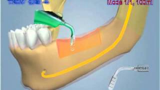 Flapless Alveolar Crest Splitting Surgical Protocol Knochenaufbau Kieferkamm  Verbreiterung [upl. by Nnaear]