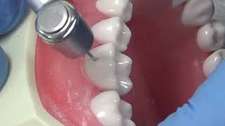 Cl I buccal pit lower 1st molar part 2 [upl. by Emiatej]