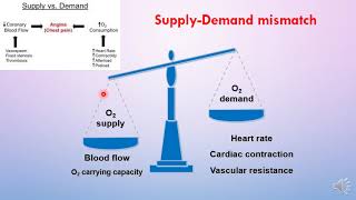 Treatment of angina [upl. by Koblick]