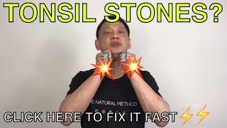 How to naturally get rid of tonsil stones [upl. by Notnerb]