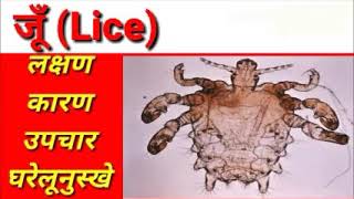 जूँ ka assan ilaj in hindi  easy treatment of lice in hindi  causes  home remedy [upl. by Jeno]