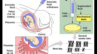 Amniocentesis vs Chorionic Villus Sampling [upl. by Yendirb158]