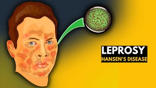 Leprosy Hansens disease Everything You Need to Know [upl. by Solrac]