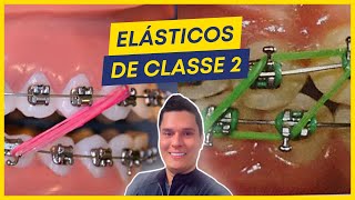 COMO TRATAR A CLASSE 2 COM ELÁSTICOS PASSO A PASSO [upl. by Enitram581]