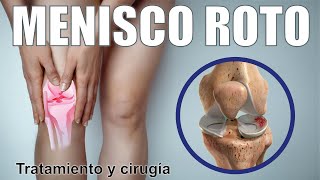 ROTURA de MENISCO 🦵🏼¿Cómo Saber Si Hay Una Lesión De Menisco 🦵🏼 Cirugía Terapia ⭐ Dr EDSON SERRANO [upl. by Ahsitaf]