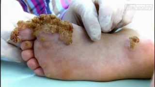 Embarrassing Bodies  Extreme Case of Warts [upl. by Neeron]