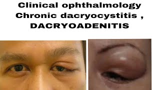 Clinical ophthalmology chronic dacryocystitis DACRYOADENITIS acute and chronic in easiest way [upl. by Arielle866]