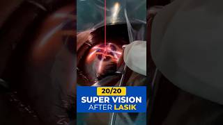 2020 Super Vision With Lasik Surgery [upl. by Gino]