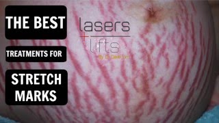 how to treat stretch marks [upl. by Alenairam240]