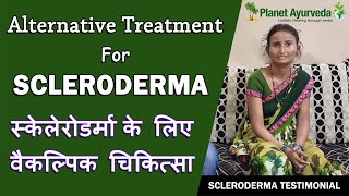 Alternative Treatment For Scleroderma  Real Testimonial [upl. by Niabi]