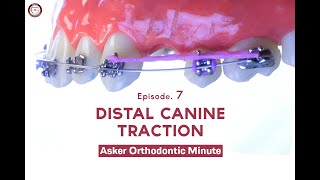 Distal Canine Traction Asker Orthodontic Minute Episode 7 [upl. by Arvonio]