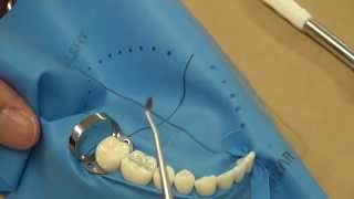 Class I Amalgam Restoration on 30 [upl. by Euqor]