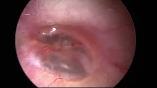 Transtympanic Steroid Injection for Idiopathic Sudden Sensorineural Hearing Loss [upl. by Yenaiv480]