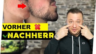 Minoxidil Bart Vorher Nachher Erfolg von Emre nach 5 Monaten [upl. by Alinoel]