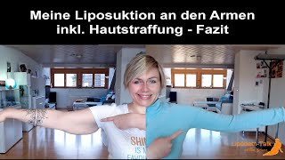 Meine Liposuktion an den Armen inkl chirurgischer Hautstraffung  Fazit [upl. by Ddene]