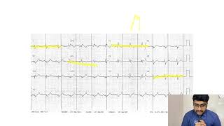 MASTERING ECGLESSON15 RIGHT BUNDLE BRANCH BLOCK RBBB [upl. by Eaned]