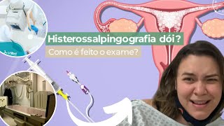 HISTEROSSALPINGOGRAFIA COMO É FEITO [upl. by Uile]