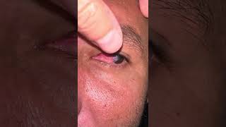 Disease Pterygium G3 eyes eyedisease [upl. by Ydna]