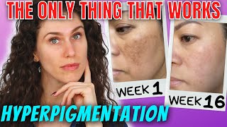 The ONLY Ingredients That Stop Hyperpigmentation And Reverse It [upl. by Meadows]