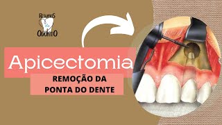 APICECTOMIA  Resumos de Odonto [upl. by Ahsit341]