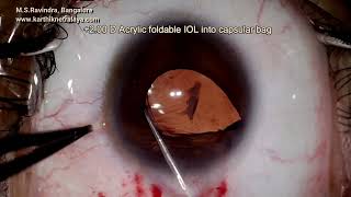 Phacosection for microcornea posterior capsular amp cortical cataract in a myopic eye [upl. by Saideman]