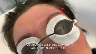 Détatouage laser des sourcils [upl. by Stiles331]