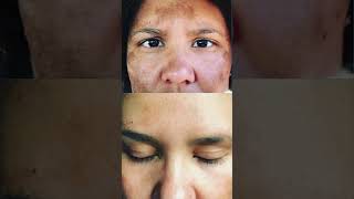 The Best Dark Spots Treatment [upl. by Alrzc]