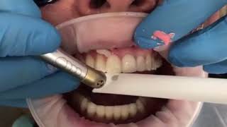 Quick and Pain free veneer removal using Waterlase laser [upl. by Sucitivel442]