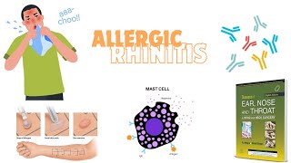 ALLERGIC RHINITISSEASONAL OR PERENNIALEARLY OR DELAYED udaipurwala dhingra otorhinolaryngology [upl. by Efram680]