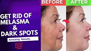 How to Treat MELASMA HYPERPIGMENTATIONDark SPOTS at home CAUSES amp prevention Detailed video [upl. by Nylqcaj]