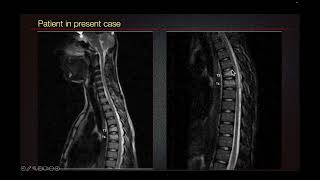 Sports Medicine Case 50 15yearold male Interesting Mechanism Leads to Uncommon Thoracic Injury [upl. by Balling855]