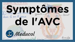 Quels sont les signes dun AVC  AVC symptômes et AVC séquelles [upl. by Gerianna]