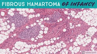 Fibrous Hamartoma of Infancy [upl. by Trabue]