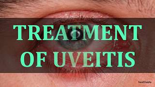 TREATMENT OF UVEITIS [upl. by Katharine]