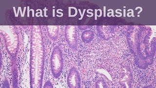 What is Dysplasia  Pathology mini tutorial [upl. by Pierrepont]